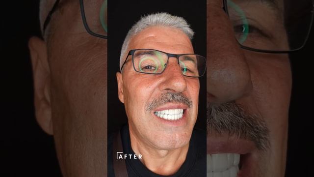 Veneers 101 A Comprehensive Guide To Veneer Teeth Enhancement