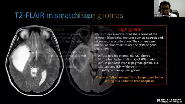 WHO CNS5 2021 Classification of Gliomas смотреть онлайн