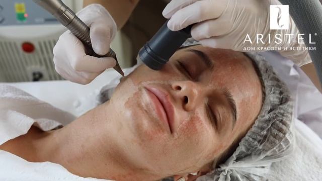 Холодный пилинг смотреть онлайн