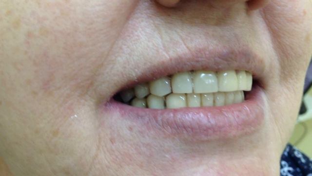 ортопедическая стоматология. металлокерамические коронки ,съемный протез смотреть онлайн