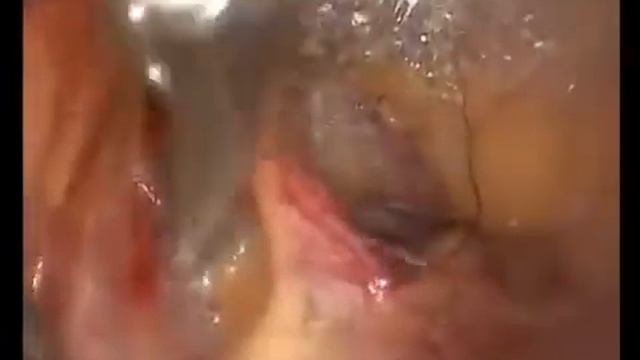 Laparoscopic Sentinel Lymph Node Dissection смотреть онлайн