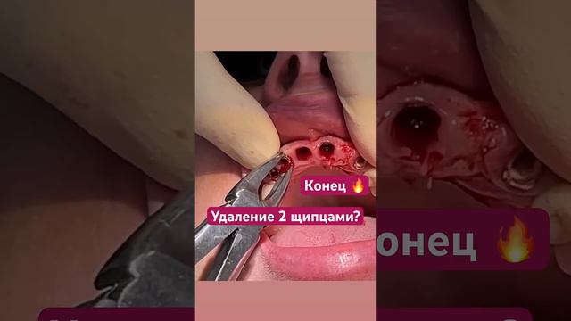 Как нужно удалять зубы?😨 #шортс #зубы #медицина смотреть онлайн