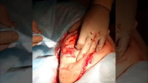 Иссечение кожно-жирового «фартука» внутренней поверхности бедра.