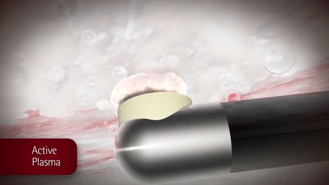 Arthrocare Radiofrequency Coblation Chondroplasty смотреть онлайн