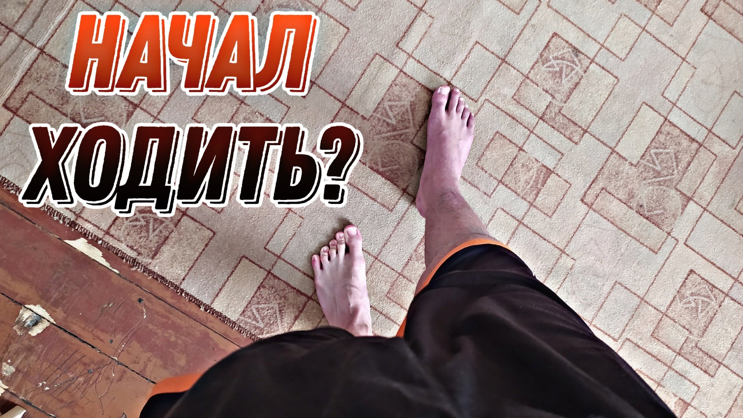 ПЕРЕЛОМ БОЛЬШЕБЕРЦОВОЙ КОСТИ//МЕСЯЦ ПОСЛЕ ОПЕРАЦИИ! смотреть онлайн