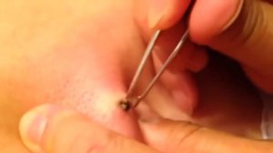 ОГРОМНЫЙ УГОРЬ! Удаление угря, большой чёрной точки в домашних условиях