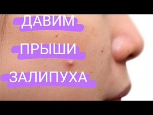 Выдавливание прыщей №27