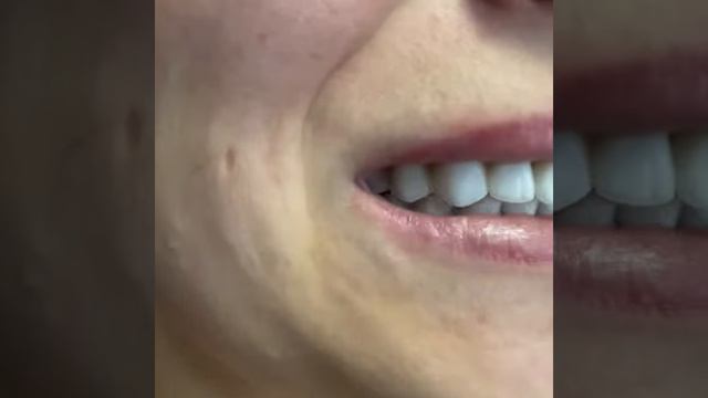 Тотальное протезирование керамическими винирами