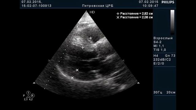ГКМП Гипертрофическая кардиомиопатия hypertrophe Kardiomyopathie смотреть онлайн