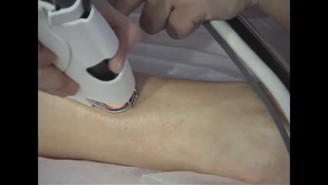 Лазерная эпиляция по технологии Quanta System смотреть онлайн