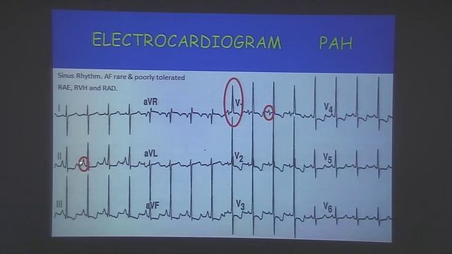 pulmonary hypertension - Dr Justin Paul смотреть онлайн