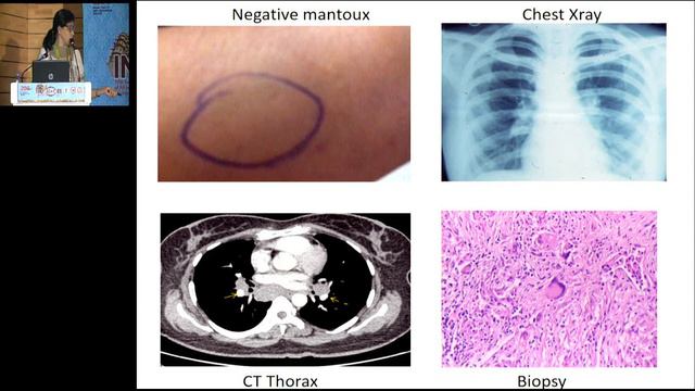 AIOC2019 - GP119 - Tips & Algorithms in Posterior Uveitis смотреть онлайн