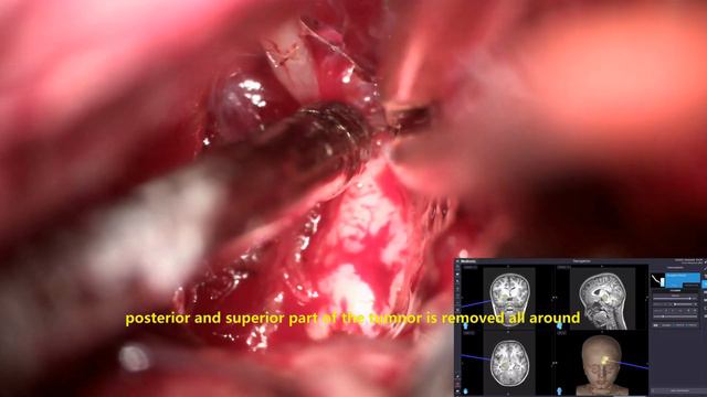 THALAMIC  MID BRAIN GLIOMA -NAVIGATION ASSISTED TRANS SYLVIAN MICROSURGICAL REMOVAL-dr Suresh Dugan