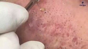 Давим угрей