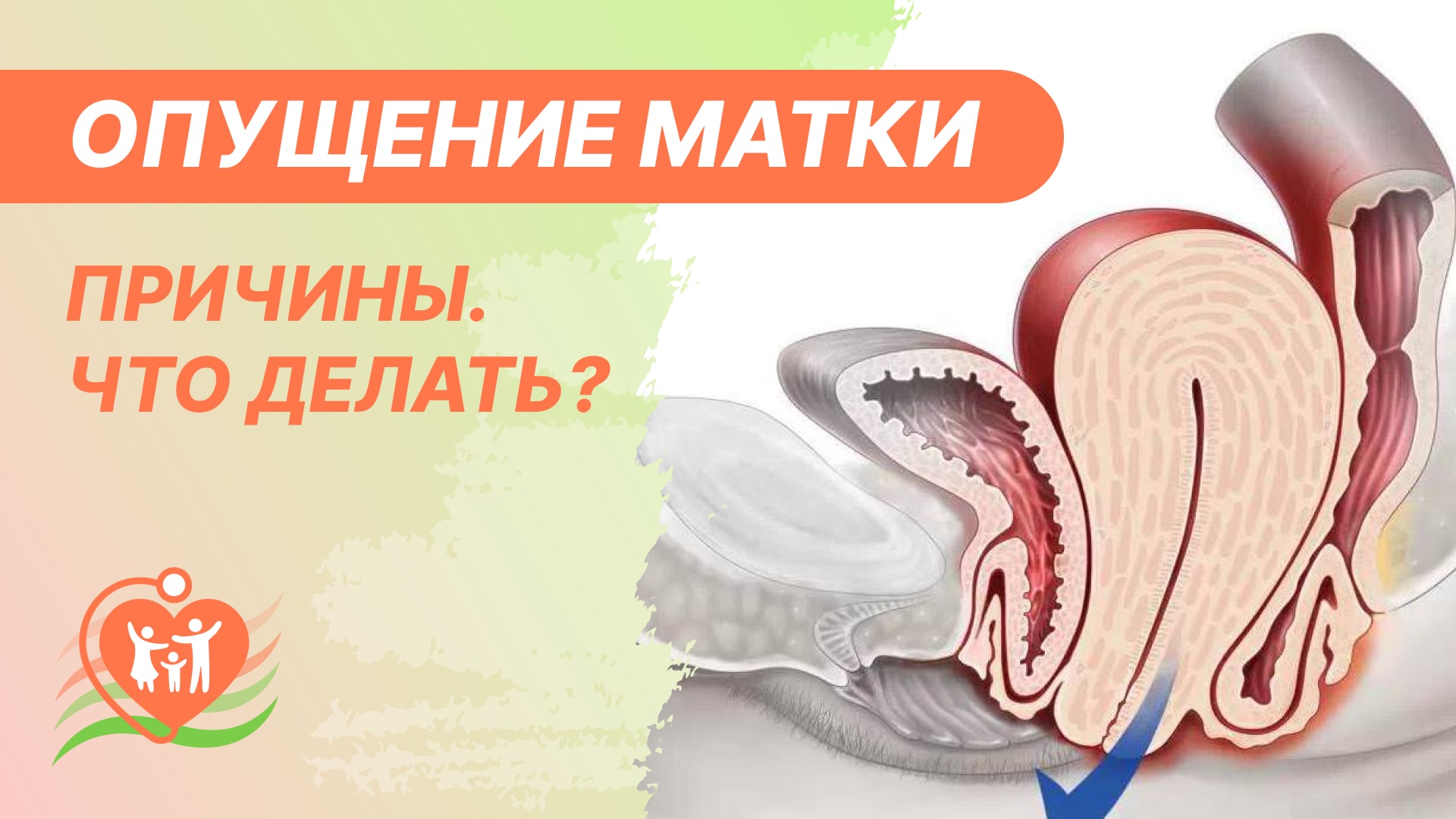⭕ Опущение матки. Причины. Чем грозит опущение или выпадение матки и что делать? смотреть онлайн