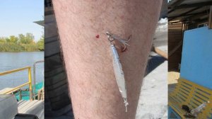 УДАЛЕНИЕ РЫБОЛОВНОГО КРЮЧКА - Порядок действий | Как вытащить рыболовный крючок | Рыбалка в Мумре