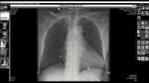 Обучающее видео «Кардиоторакальный индекс»