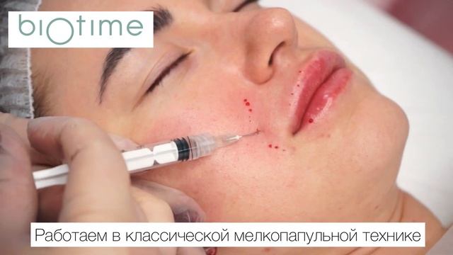 Biomatrix Topaz. Биоревитализация периоральной области смотреть онлайн