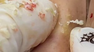 давит#прыщи#прыщиналице