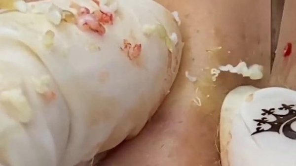 давит#прыщи#прыщиналице