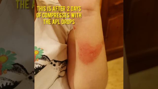 #Ожог #кипятком #Verbrennung Bei #Kinder