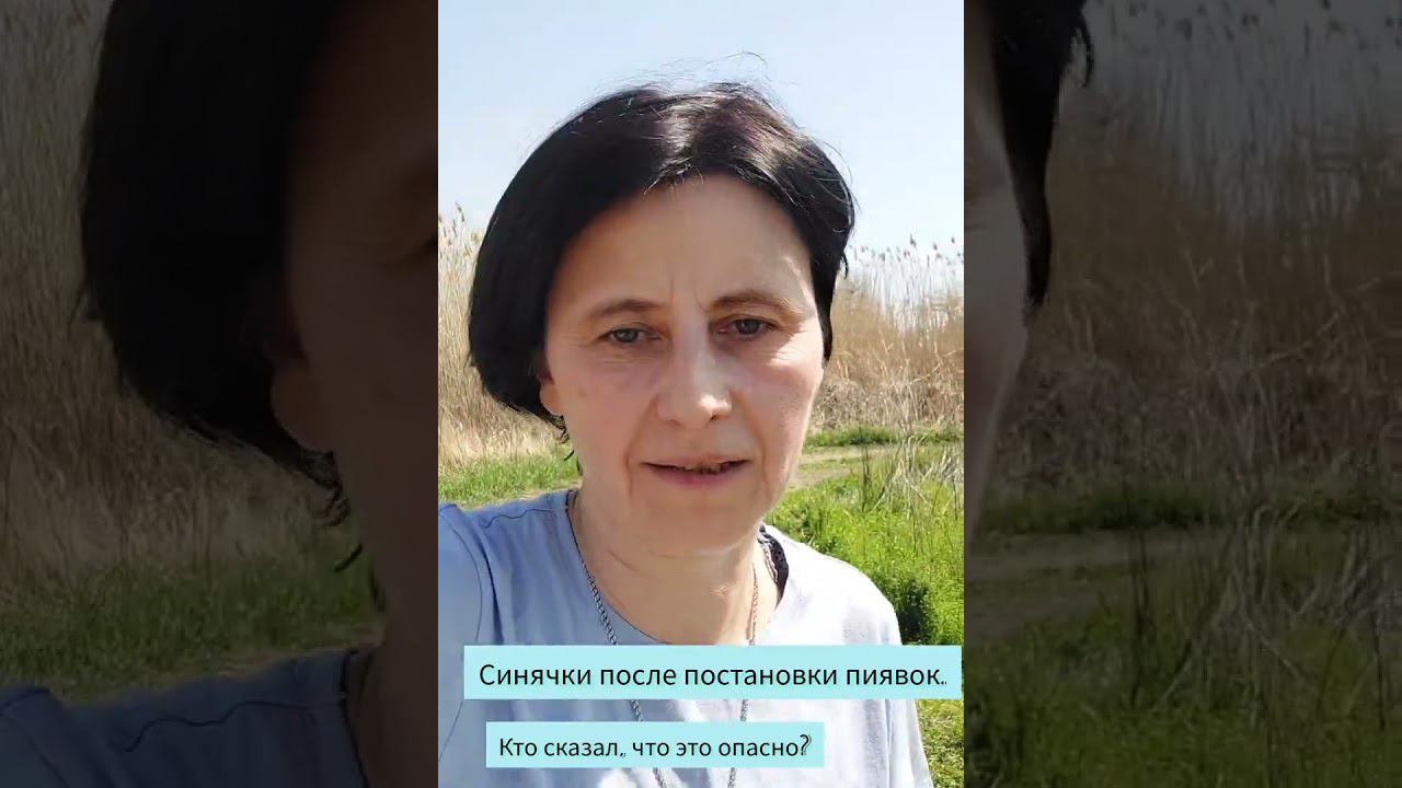 Синячки после пиявок. смотреть онлайн