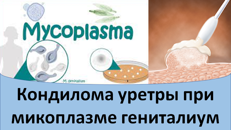 Кондилома уретры при микоплазме гениталиум смотреть онлайн