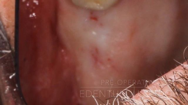 Guided Implant Surgery смотреть онлайн