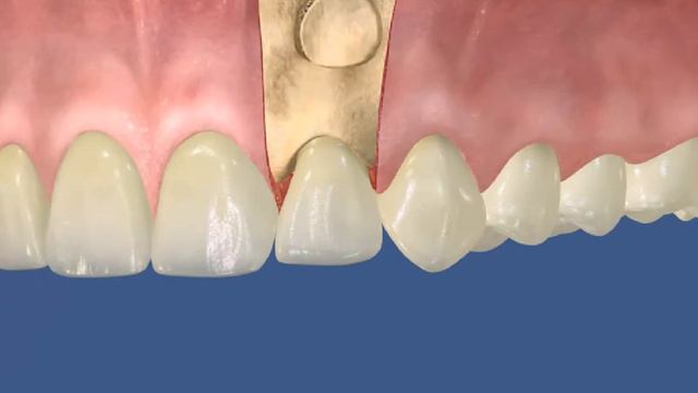 Лечение корня Резекция верхушки корня смотреть онлайн