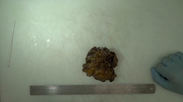 Вырезка панкреатодуоденальной резекции (ПДР) в лаборатории UNIM