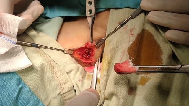 cervical lymph node biopsy by Dr. Mohamed Elshamaa смотреть онлайн