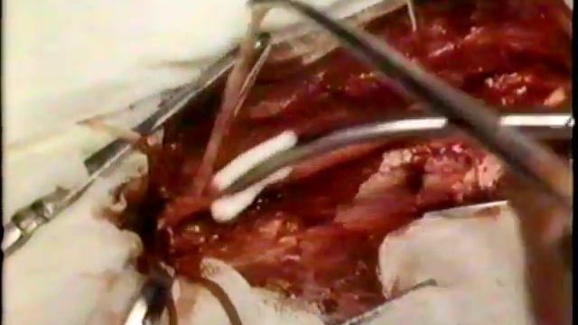 Открытая эндартерэктомия из бедренной артерии. Академик М.И.Кузин © Open Endarterectomy