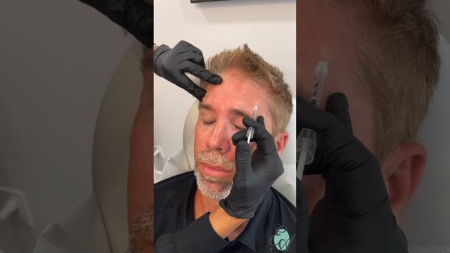 Frontalis Botox Injections смотреть онлайн