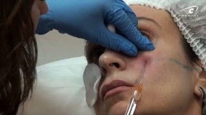 Коррекция носослезной борозды филлерамии канюлей. Мастер-класс косметолога