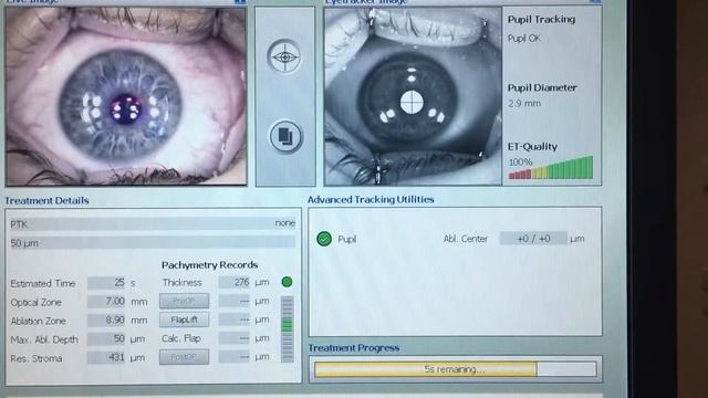 Trans PRK Topoguided Contoura Vision (technique no touch 100% laser) смотреть онлайн