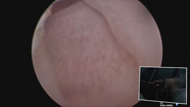 Friendly Meeting 2017 - Caso 3, Mioma G1-G2 20-22mm, Dr. Ivano Mazzon смотреть онлайн