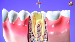 Что делать, если зуб раскрошился Д А  Воробьев