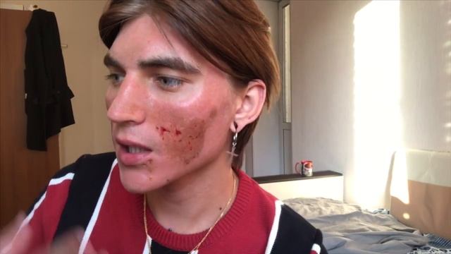 ШОК!СОЖГЛИ КОЖУ ЛАЗЕРОМ