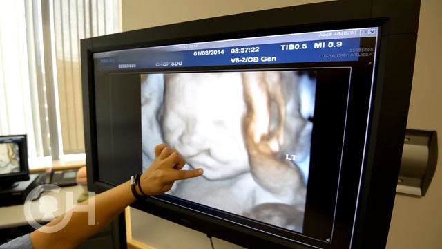 Explaining Cleft Lip and Palate (1 of 7) смотреть онлайн