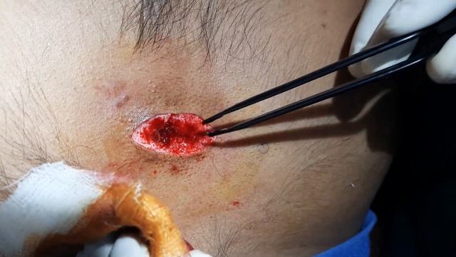 Keloid Surgery and Laser Treatments are available to avoid recurrence in future. Contact:970002-080 смотреть онлайн