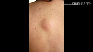 Как избавиться от жировика