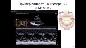 Основы эхокардиографии.   Измерения в М режиме