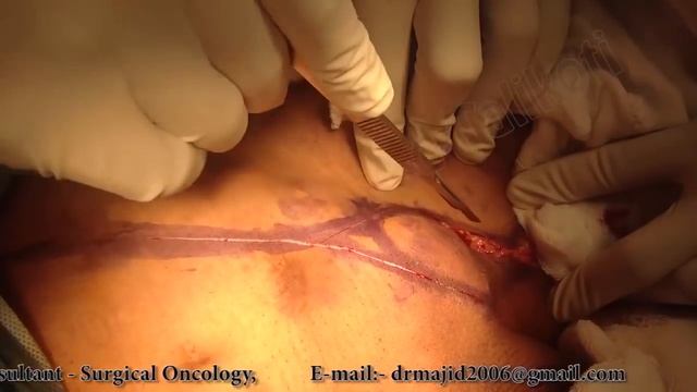 Total Panectomy with Ilio Inguinal Lymphnode Dissection by Dr Majid Ahmad Talikoti смотреть онлайн