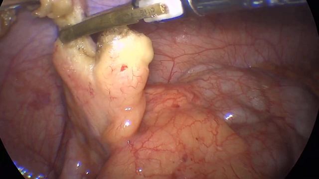 лапароскопическая аппендэктомия смотреть онлайн