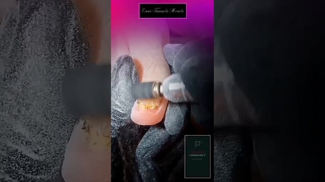 Онихогрифоз. Утолщение и деформация ногтей. см. в описании. смотреть онлайн