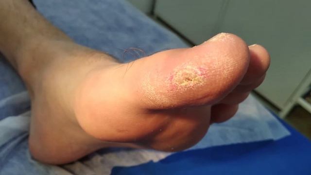 Удаление бородавки 3 смотреть онлайн