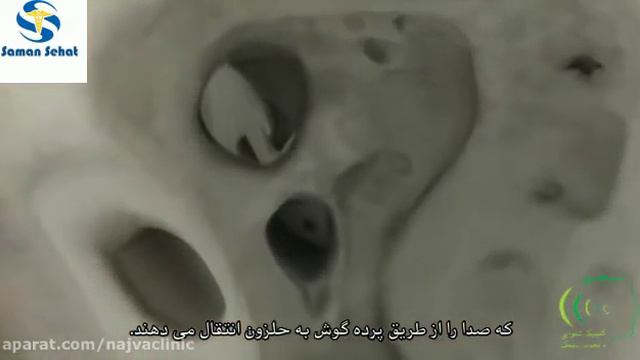 Что такое кохлеарная имплантация? смотреть онлайн