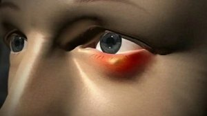 Как Быстро Вылечить Ячмень на Глазу ? Несколько Способов!