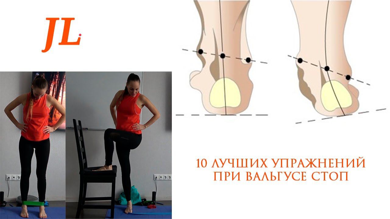 10 ЛУЧШИХ УПРАЖНЕНИЙ ПРИ ВАЛЬГУСЕ СТОП смотреть онлайн