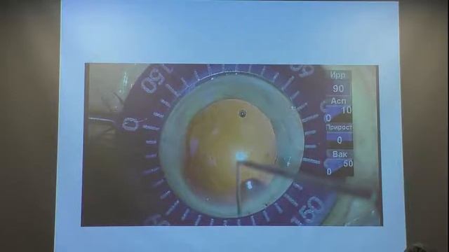 Результаты интраокулярной коррекции роговичного астигматизма при факоэмульсификации смотреть онлайн